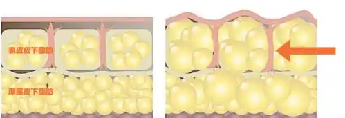 不碰在衰老过过程皮下脂肪最容易流失的部位.