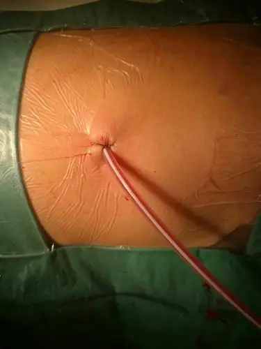 微创手术后的手术切口