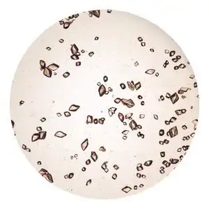 尿沉渣中的尿酸晶体照片