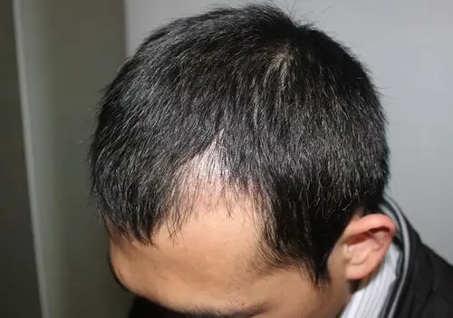 广东新发现植发医院