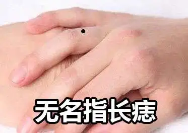 无名指长痣代表什么含义