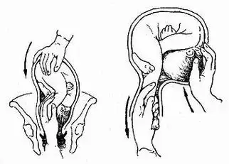 25%,称为胎儿横位.