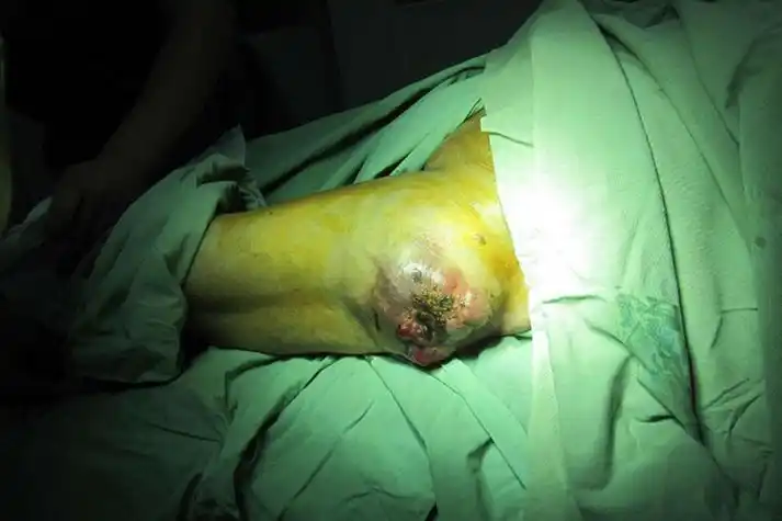 大腿肌肉瘤图片