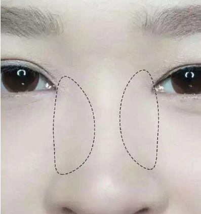 低鼻梁怎样增高比较快