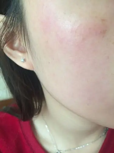 olay小绿瓶美白精华有没用了过敏的?