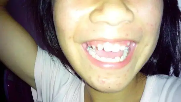 她虎牙长得很小,但在虎牙的外面,也就是牙床外面又长出两个牙根