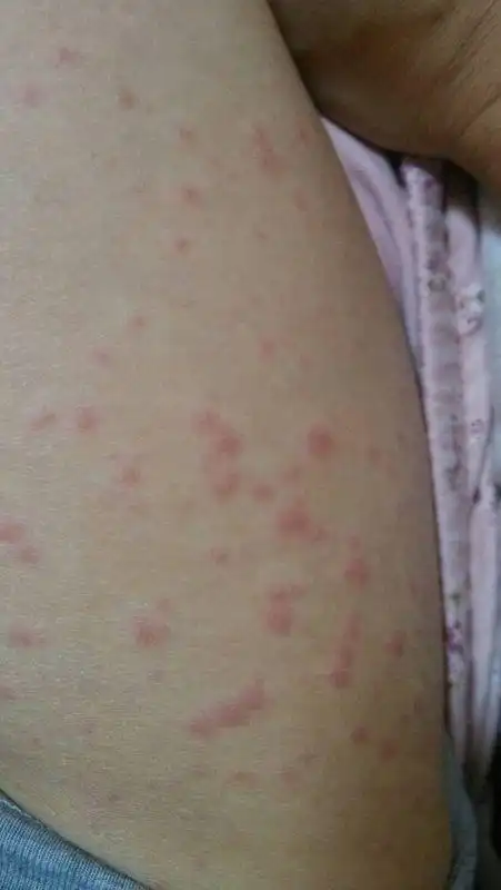 请问是皮肤过敏吗?身体上下都是,只有手掌