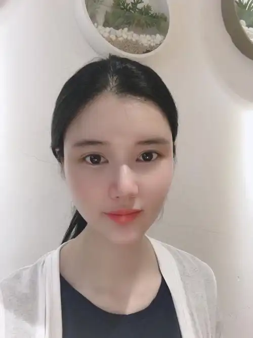 【青岛华颜美-自体脂肪填充面部术后第7天】