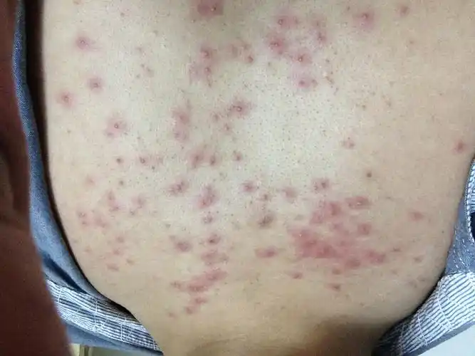 突然间长了这些疹子,不知道有哪位高人知道是什么