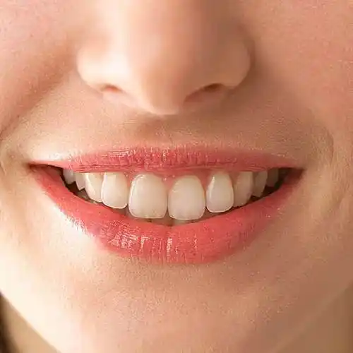 正常咬合的露齿笑