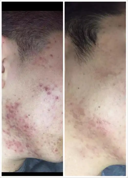 粉刺痤疮前后对比