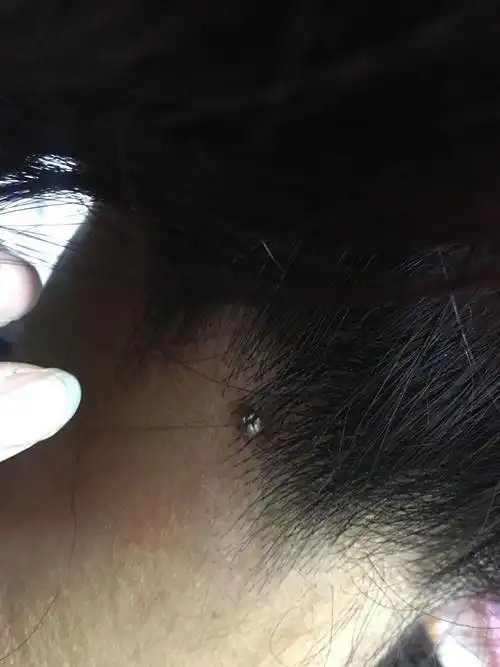 眼头和眼上的位置分别用眼线笔点上了痣眼下痣火了黑色肉痣会癌变吗