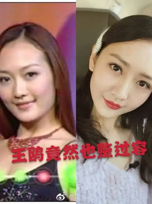 王鸥整容了吗