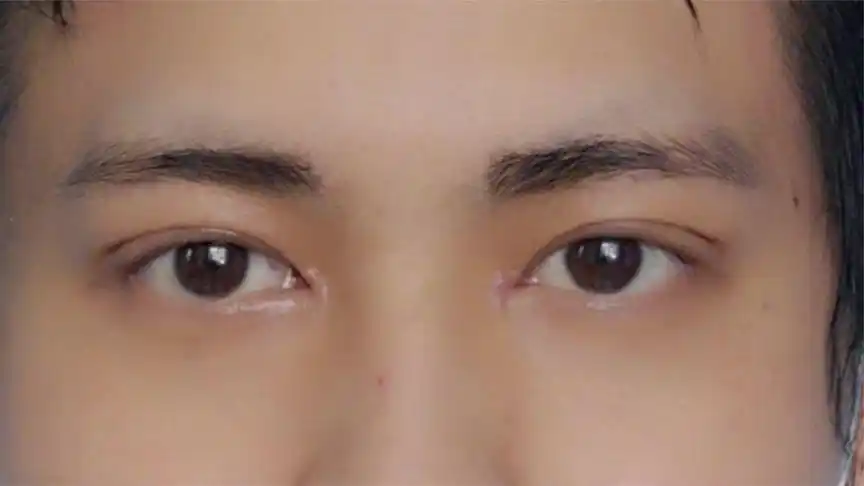 男生双眼皮第7天,是你喜欢的类型吗?