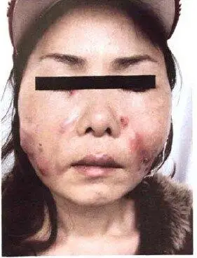 面部注射美容后感染——分枝杆菌感染_注射美容_注射