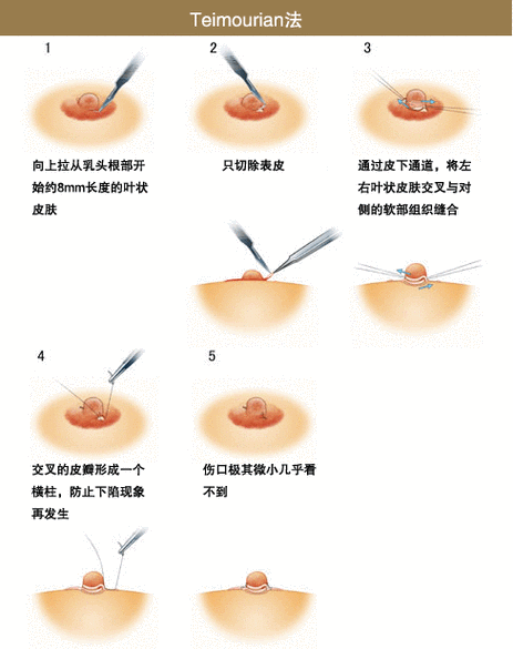 乳头内陷矫正