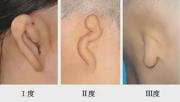耳廓畸形莫忽视,抓住黄金治疗期!