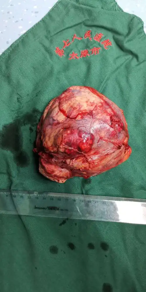手术标本,大小约13cmx13cmx15cm,包膜完整,脂肪肉瘤可能