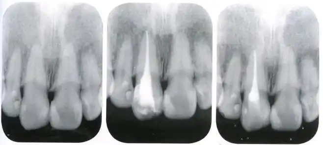 上颌切牙,尖牙的解剖特征与根管预备的策略_形态