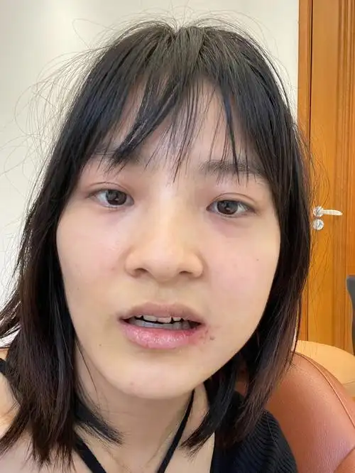 拔智齿一周后的对比