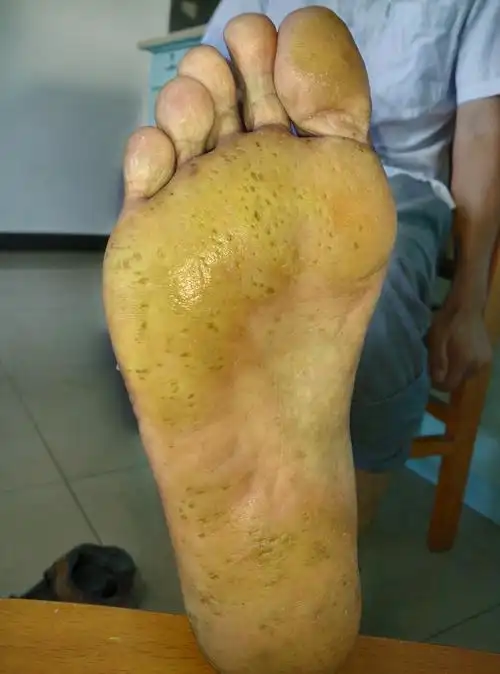 反复发作持续生长的双足底皮肤大面积角质化 - 皮肤及性传播疾病讨论