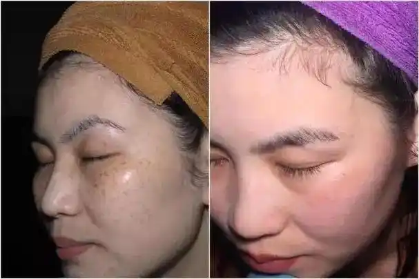 "小气泡"美容能收缩毛孔,提高皮肤活力,但警惕术后留疤