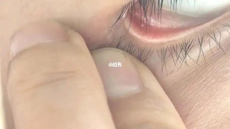 下眼睑长了个白点怎么回事