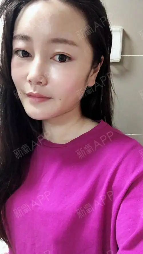 【自体脂肪填充面部第3天】