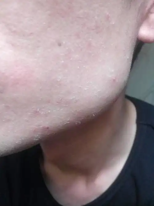 刚洗完脸,干燥起皮,一年四季都这样,是什么原因,求大神解答