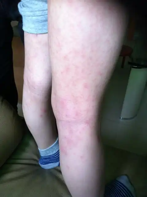 皮肤科    2013-06-25 12:17提问者采纳 看的不是很清楚,过敏性