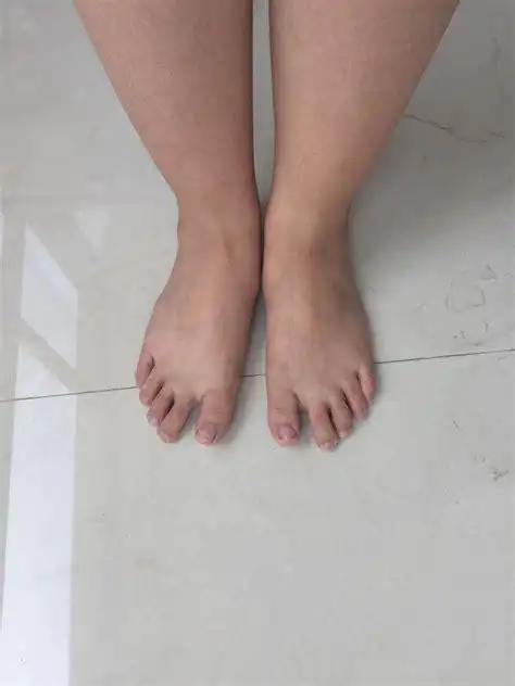 女生脚趾拇外翻是什么样体验? - 知乎