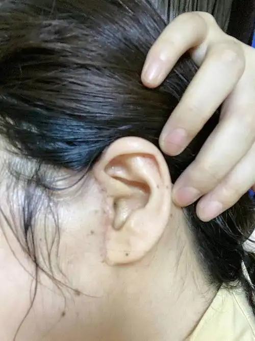 小切口拉皮第10天