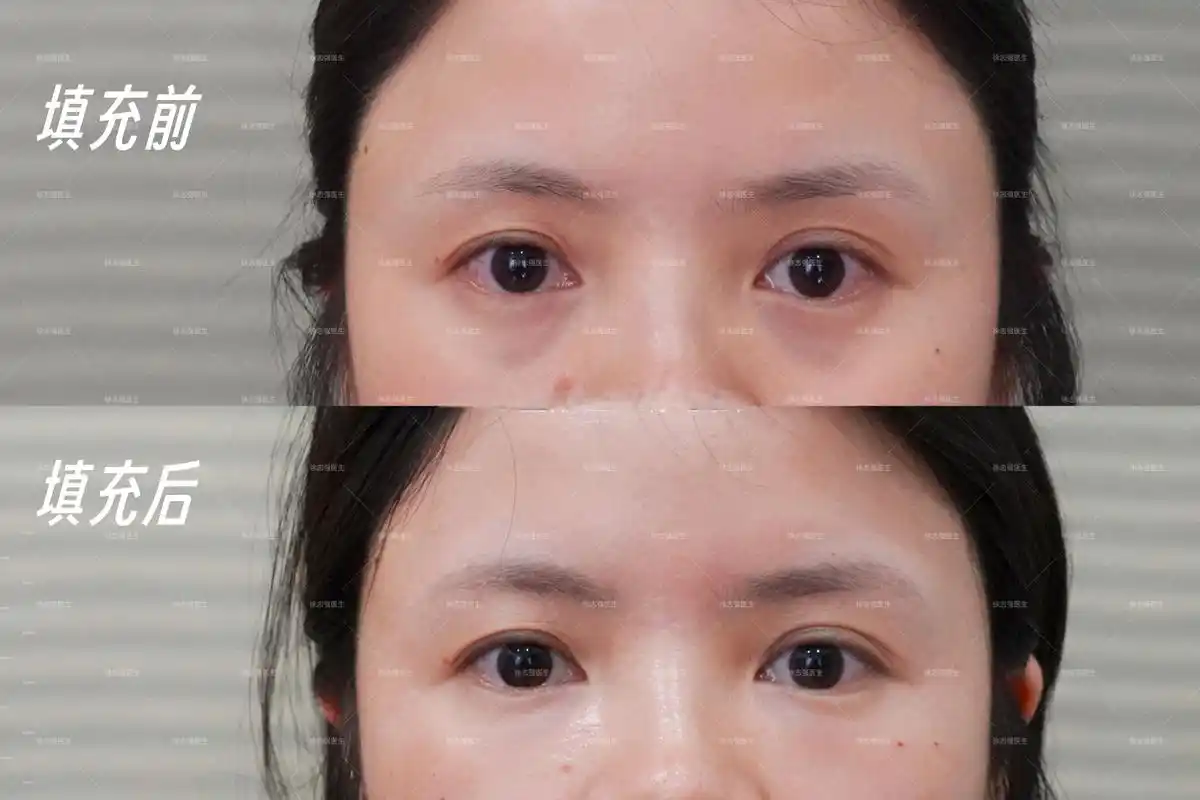 双侧泪沟,单侧颧沟,脂肪胶填充术后1天 #徐志强医生案例##自体脂肪
