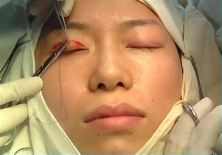 埋线双眼皮结节图片