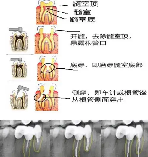 根管治疗有哪些风险?_牙齿