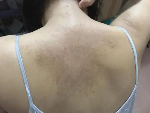 后背皮肤骚痒,总是手抓,就成了这可怕的样子,有知道这是什么皮肤病吗?