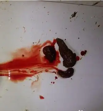 胃癌来临前,身体上有4个征兆势必会出现,需警惕