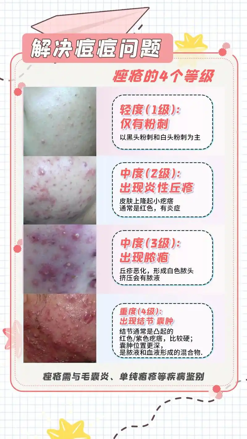 快喊你的对象来看,皮肤科医生教你如何正确处理痘痘