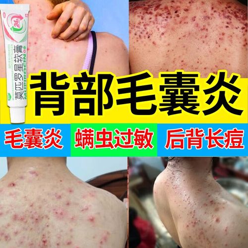 毛囊炎背部毛囊炎专用药皮肤外用药 螨虫过敏引起的毛囊炎 前胸后背
