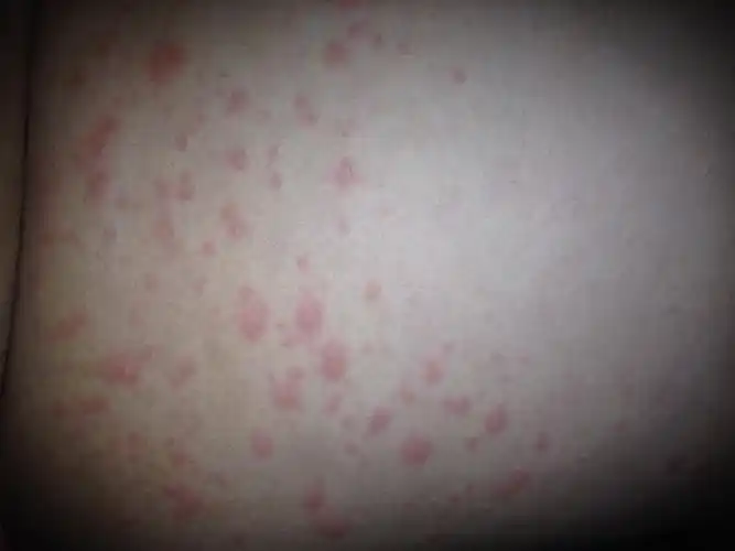 身上出大片红疙瘩,奇痒难忍,这是怎么了,该怎么治疗?谢谢!