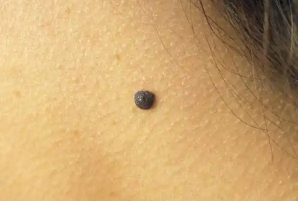 "古人说痣"顺口溜:长痣有说法,8大"富贵痣",看看你有吗?