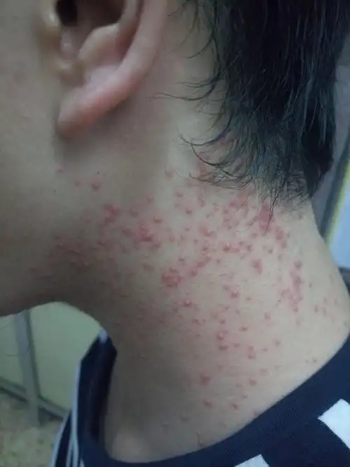 马拉色菌毛囊炎