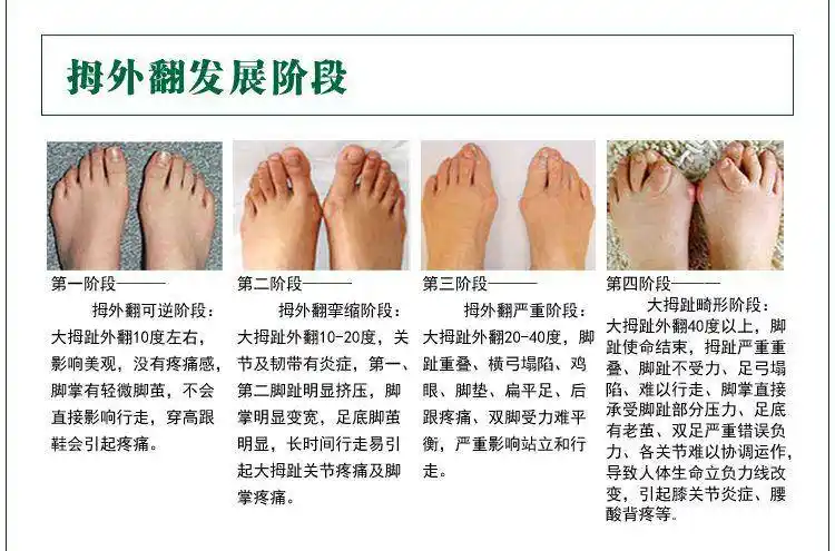 拇外翻发展阶段示意图为了让大家能够充分了解拇外翻到底是一种什么病