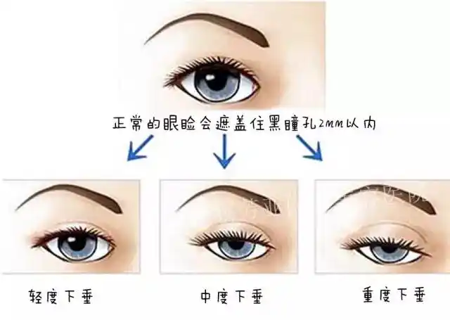 上睑下垂是种病态的功能丧失,和双眼皮手术是有区别的