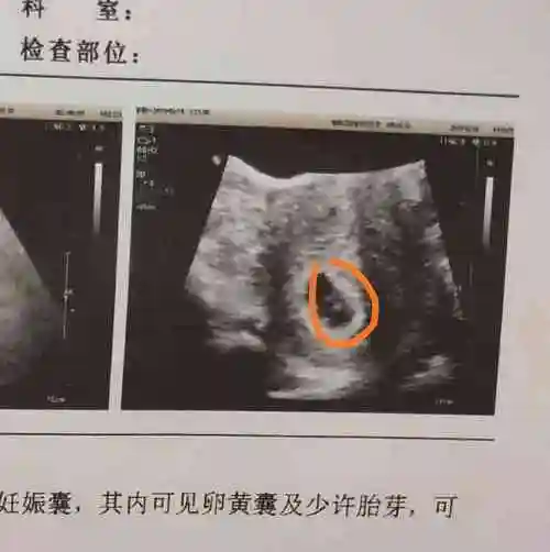 男孩胎芽图和女孩胎芽图有什么不同