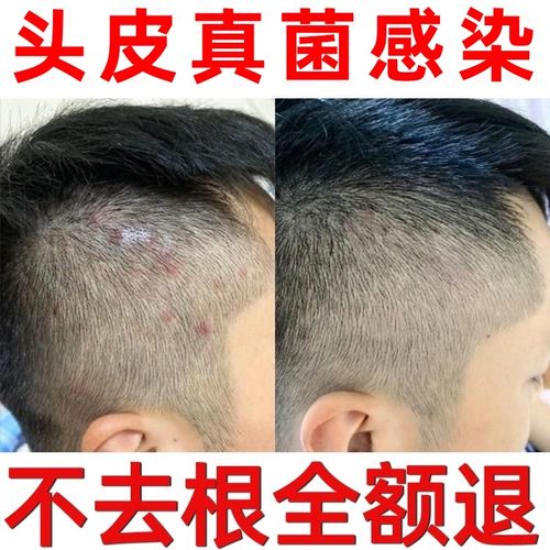 头皮癣专用药膏头皮屑癣治疗头部牛皮藓癣真菌感染银屑病外用药膏