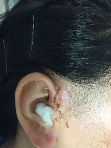 患者先天性耳前瘘管感染来院切开排脓,之后每天换药,现在入院第十天了