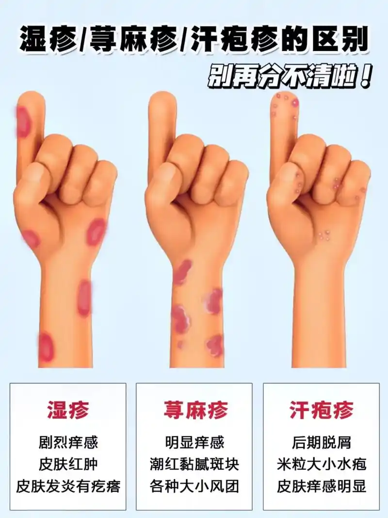 教你一张图弄懂!#湿疹 #荨 - 抖音