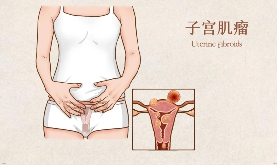 你的子宫条件达到做泰国试管婴儿的标准了吗