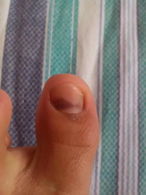 大脚趾甲里面呈暗紫色,不痛不痒,快一个星期了